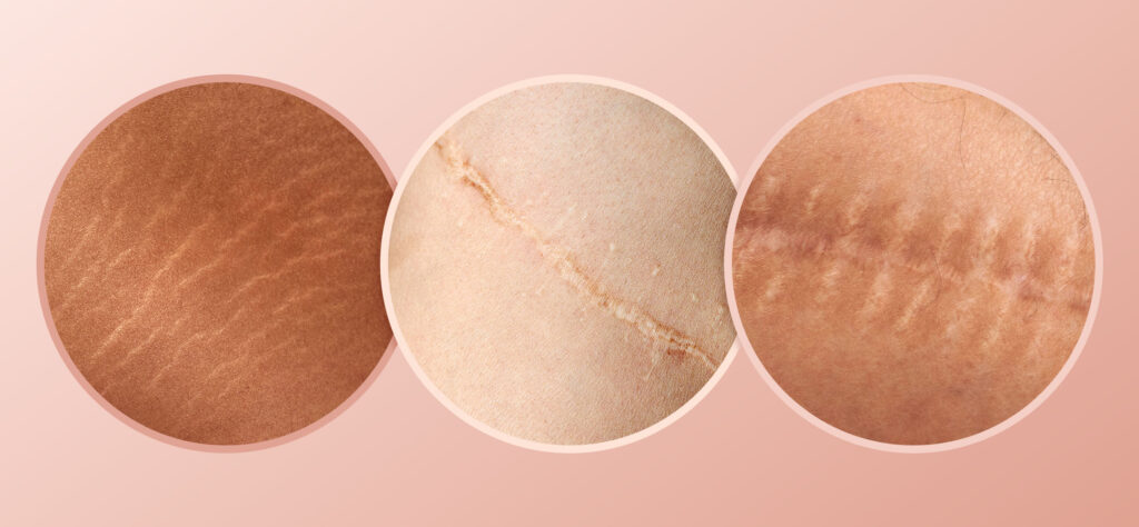 Comment le camouflage cutané et le tatouage médical redonnent confiance après des cicatrices